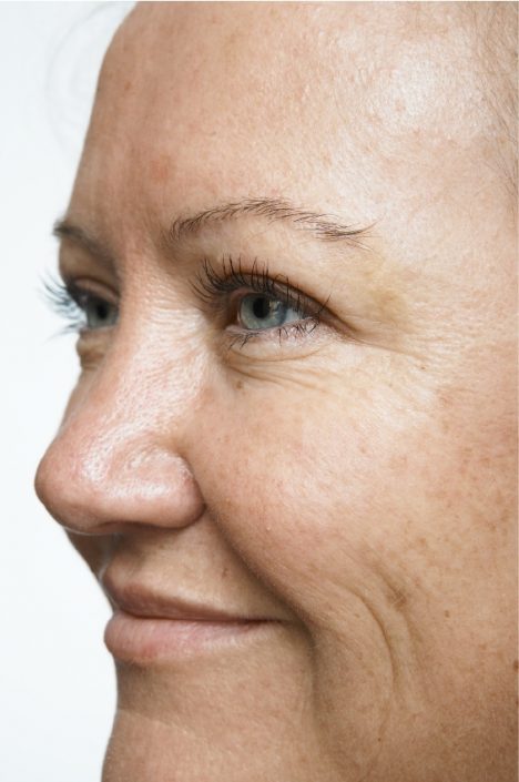 Crows Feet After