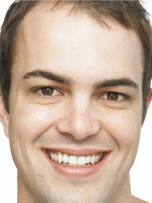 Male After Wrinkle Relaxers