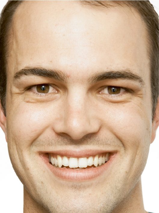 Male Before Wrinkle Relaxers