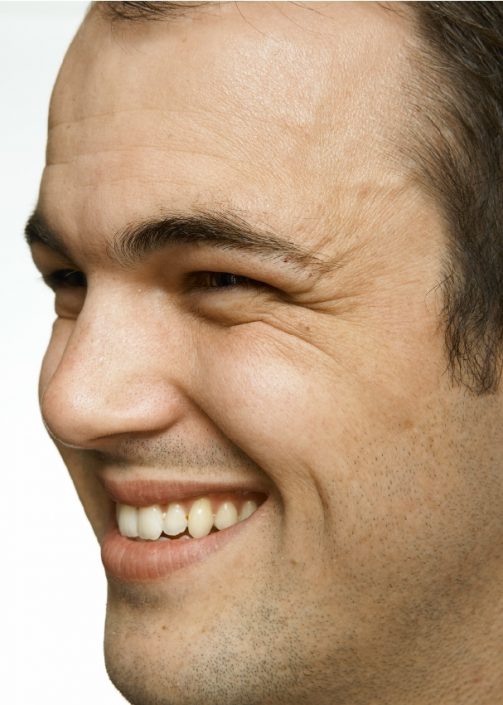 Male Crow’s feet Before