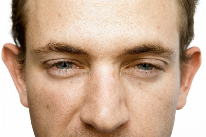 Male Frown line – After